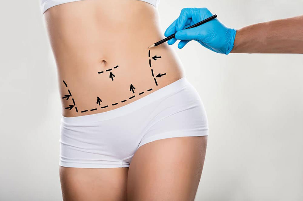 Abdominoplastika – korekcia brušnej steny